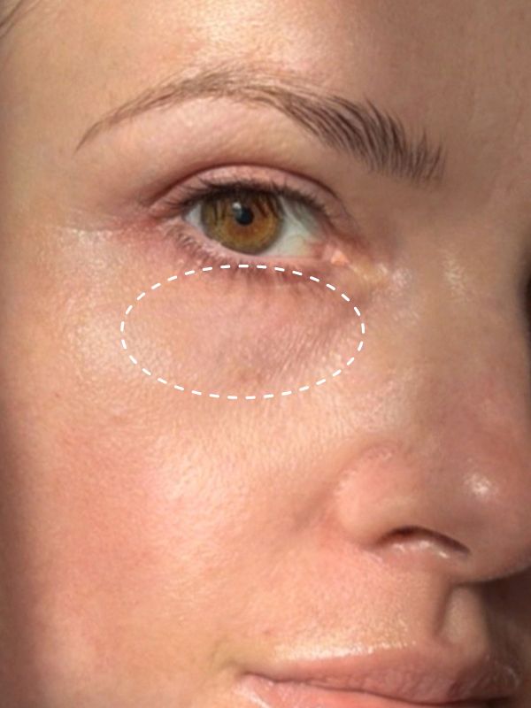 After: Before and after 28 days of The Signature Caviar Eye Cream