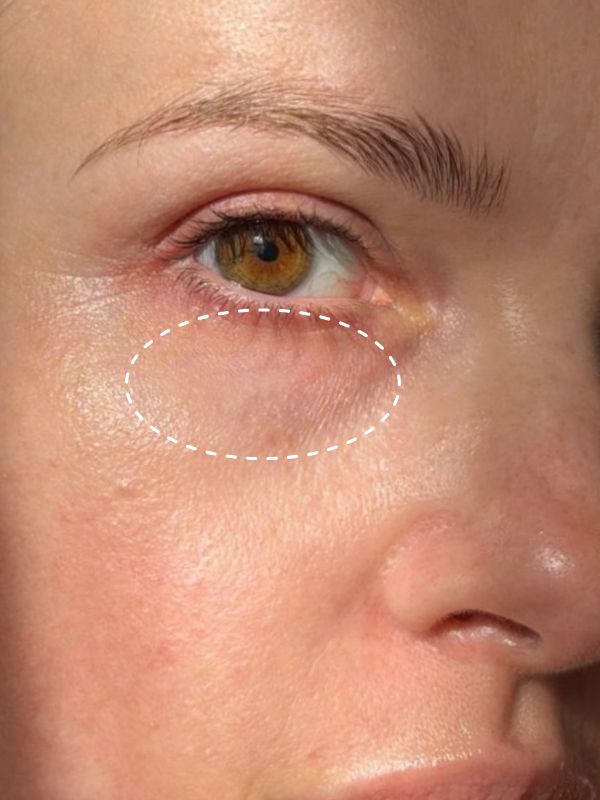 Before: Before and after 28 days of The Signature Caviar Eye Cream